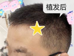 -大麦微针植发全国连锁