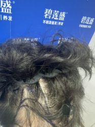 -碧莲盛不剃发植发