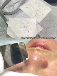 -靓芙泉祛痘.科技美肤连锁