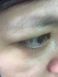 -爱莎扁平疣·汗管瘤·斑痣中心