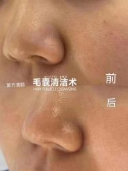 -苗方清颜专业祛痘连锁机构
