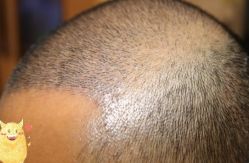 -大麦微针植发丨全国连锁