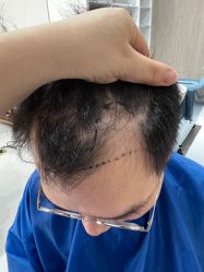 体验前-大麦微针植发全国连锁