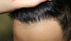 -大麦微针植发丨全国连锁