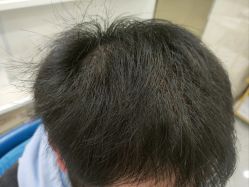 点击看大图 -碧莲盛·不剃发植发