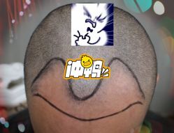 -大麦微针植发全国连锁