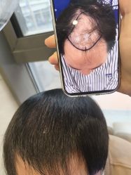 -碧莲盛·不剃发植发