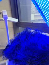 -碧莲盛·不剃发植发