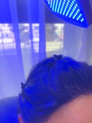 -碧莲盛·不剃发植发