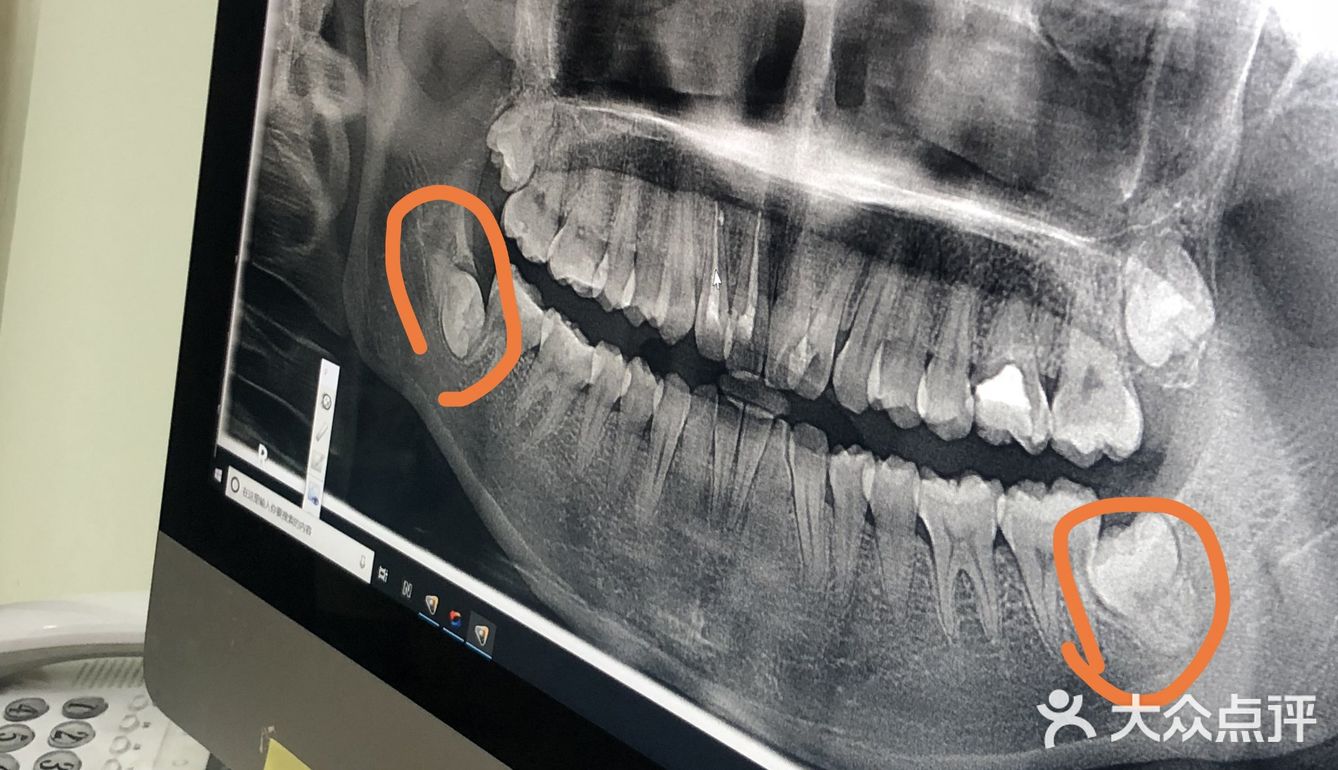 定期洁牙给你带来的意外和惊喜