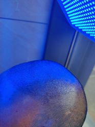 -碧莲盛·不剃发植发