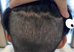 -大麦微针植发全国连锁