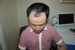 -大麦微针植发丨全国连锁