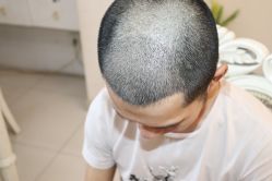 -大麦微针植发丨全国连锁