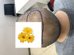 -大麦微针植发丨全国连锁