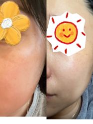 体验前-More摩尔医美の注射线雕光电中心