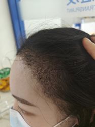 -大麦微针植发全国连锁