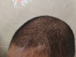 -碧莲盛·不剃发植发