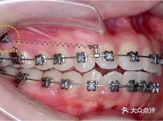 整牙时，很多患者有两大“害怕”，一怕拔牙，二怕打骨钉