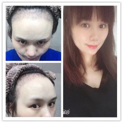 -大麦微针植发丨全国连锁