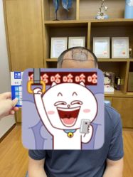 体验前-大麦微针植发全国连锁