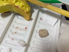 -上海仁爱医院口腔科 · 种植