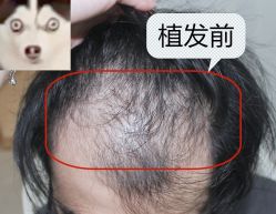 -大麦微针植发全国连锁