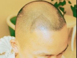 -大麦微针植发丨全国连锁
