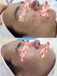 -时光畔·酷雪·痘肌