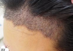 -大麦微针植发丨全国连锁