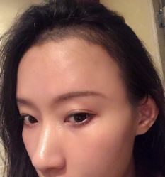 点击看大图 -碧莲盛·不剃发植发