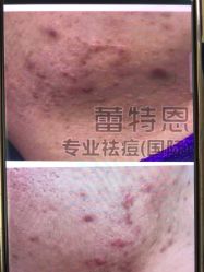 -蕾特恩专业祛痘·皮肤管理