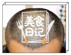 -大麦微针植发全国连锁