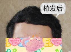-大麦微针植发全国连锁