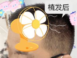 -大麦微针植发全国连锁