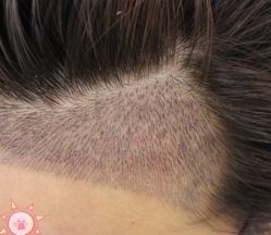 -大麦微针植发丨全国连锁