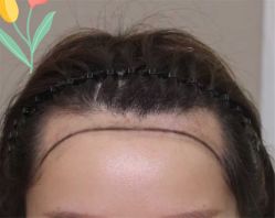 点击看大图 -大麦微针植发全国连锁