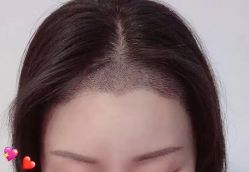 -大麦微针植发丨全国连锁