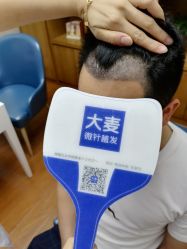 -大麦微针植发全国连锁