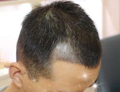 -大麦微针植发全国连锁