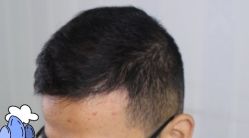 -大麦微针植发丨全国连锁