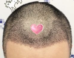 -大麦微针植发全国连锁