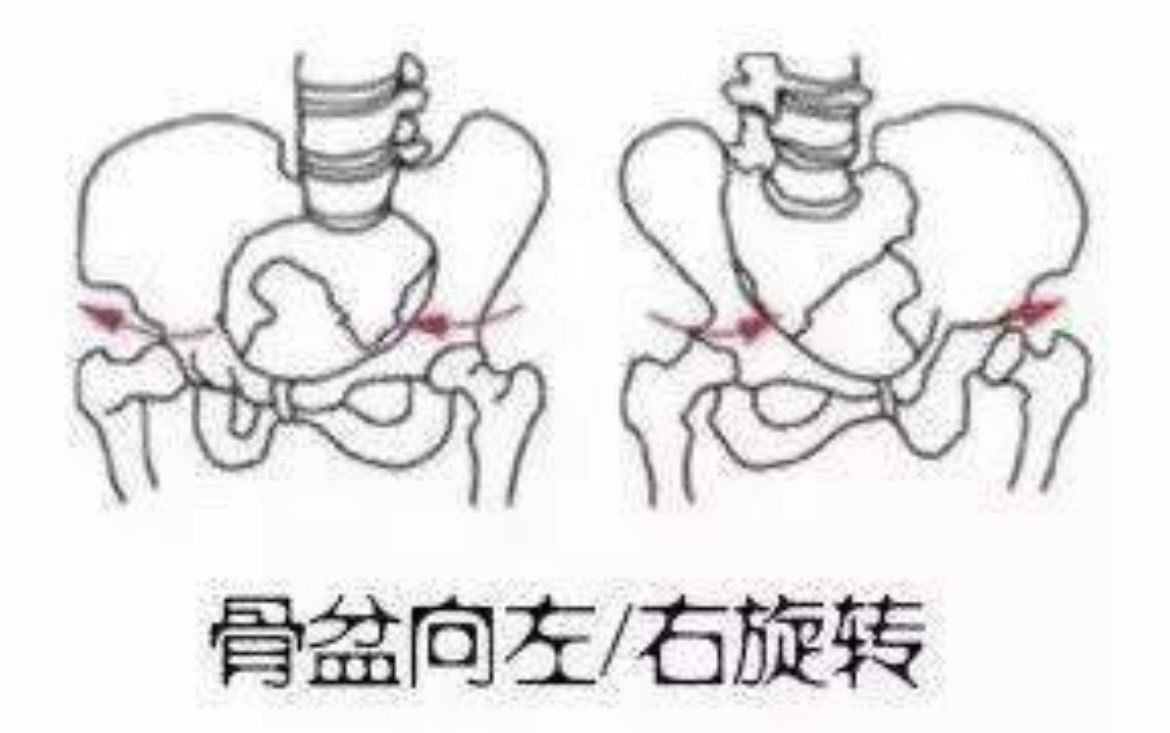 骨盆右旋怎么办