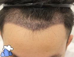 -大麦微针植发丨全国连锁