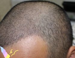 -大麦微针植发丨全国连锁