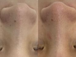 体验前-凡碧诗毛孔清洁收细