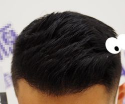 -大麦微针植发全国连锁