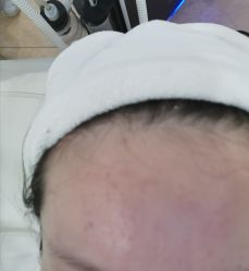 -塑青春&伊肤泉祛痘皮肤管理