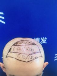 -雍禾植发全国连锁