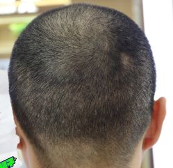 -大麦微针植发丨全国连锁